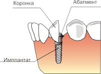 Имплантация