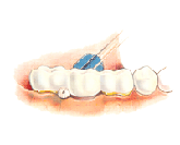 Чистка зубным ершиком