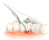 Чистка держателем флосса