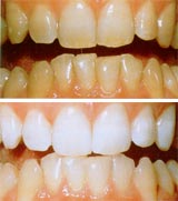 Отбеливание зубов