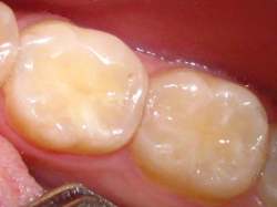 Пломба зуба